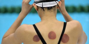 landscape-1470774002-coppettazione-come-funziona-cupping-therapy